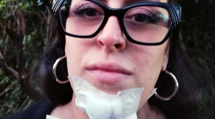 Sabrina ferita dalla sassaiola sulla Statale 268: “Fermiamoli prima che ci scappi il morto”